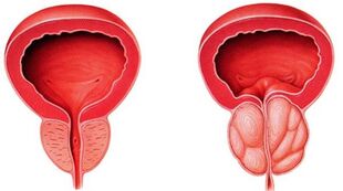 prostatitis