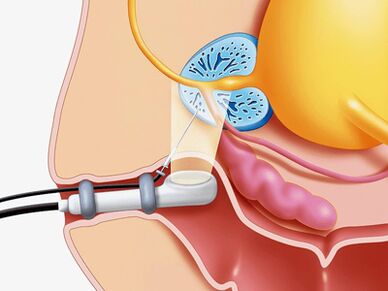 Prostate puncture biopsy