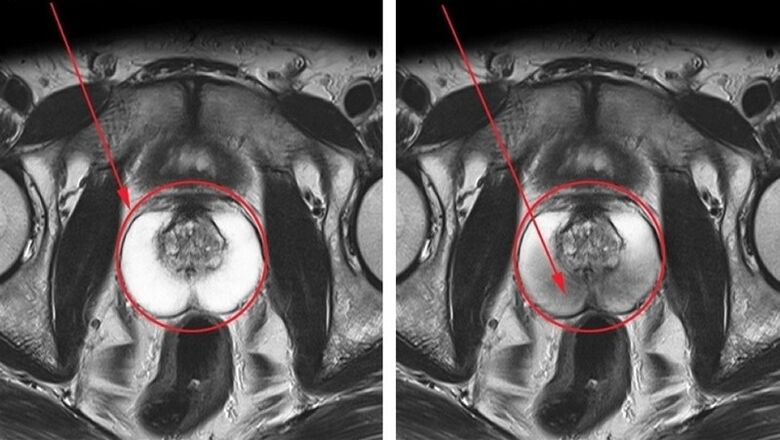 a healthy prostate and inflamed with chronic prostate