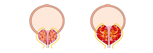healthy prostate and inflamed prostate