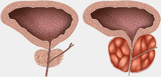 healthy and diseased gland