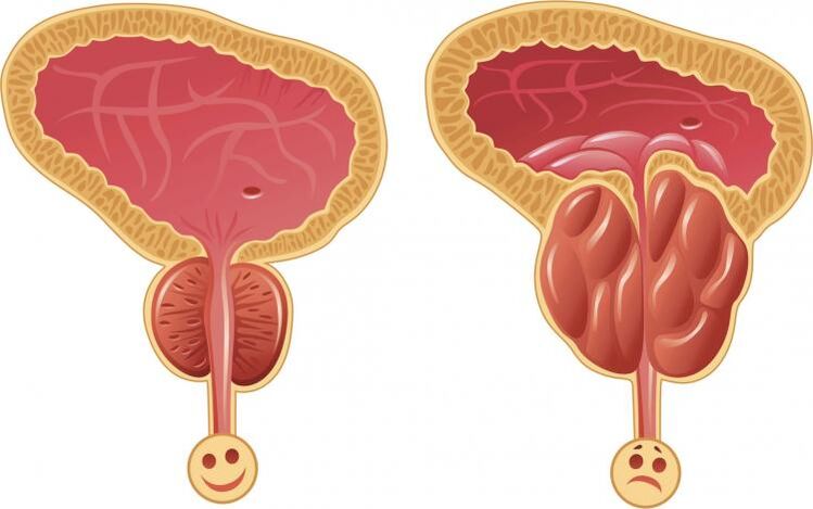Healthy prostate and prostate